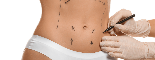 mini-abdominoplastia