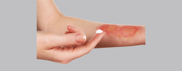 cirurgia-reparadora-de-queimadura